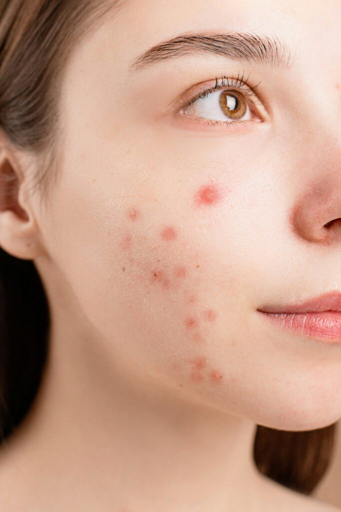 best moisturizer for acne prone skin