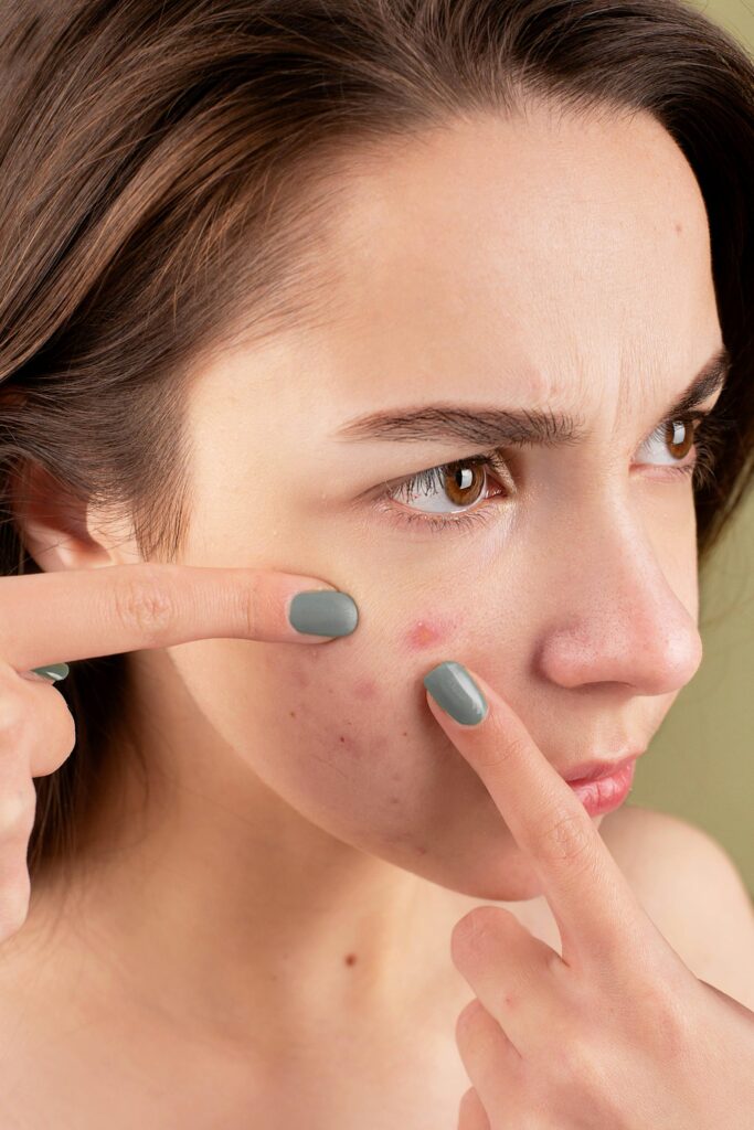 best moisturizer for acne prone skin