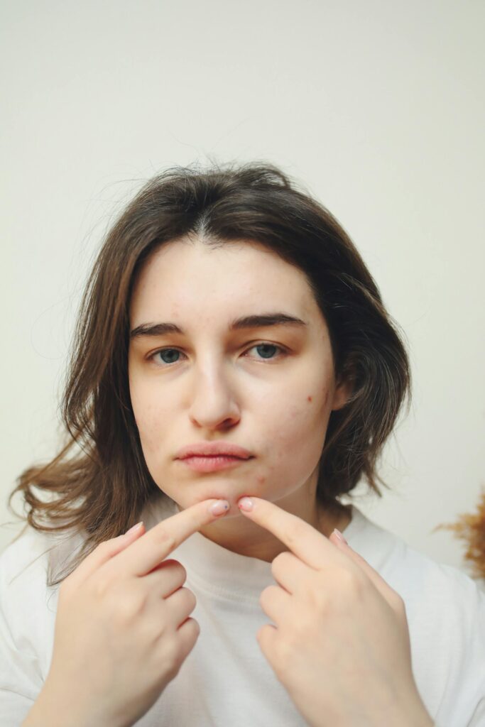 best moisturizer for acne prone skin