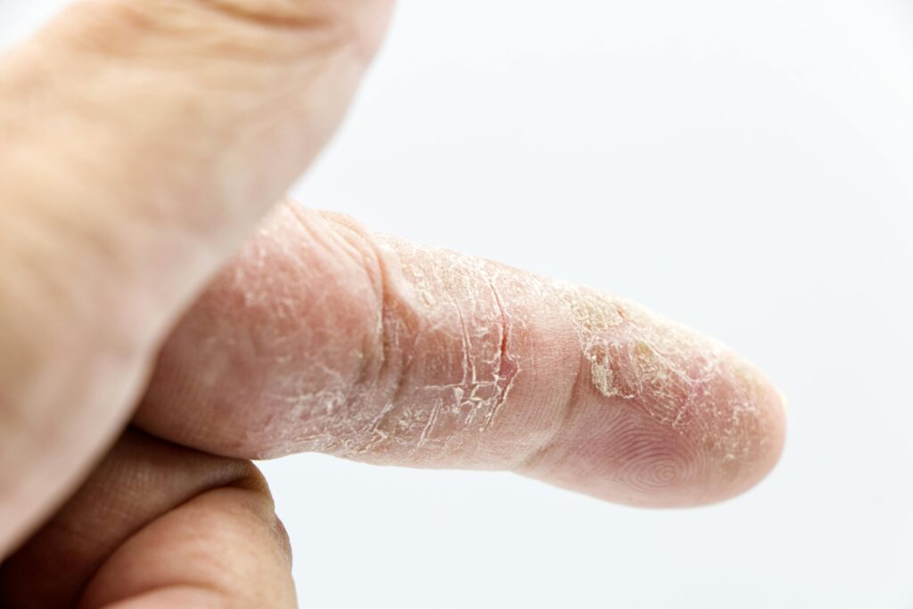 dehydrated skin vs dry skin